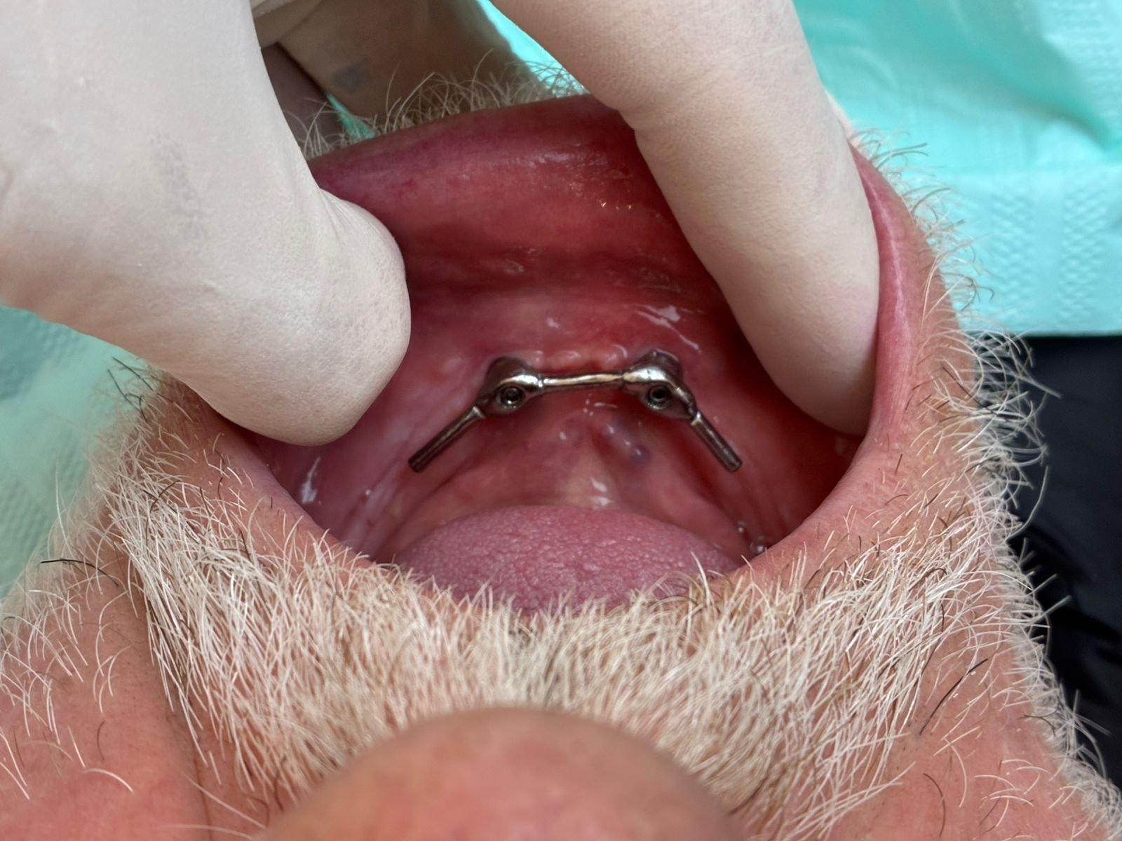 Imagem ilustrativa de Prótese Overdenture 4
