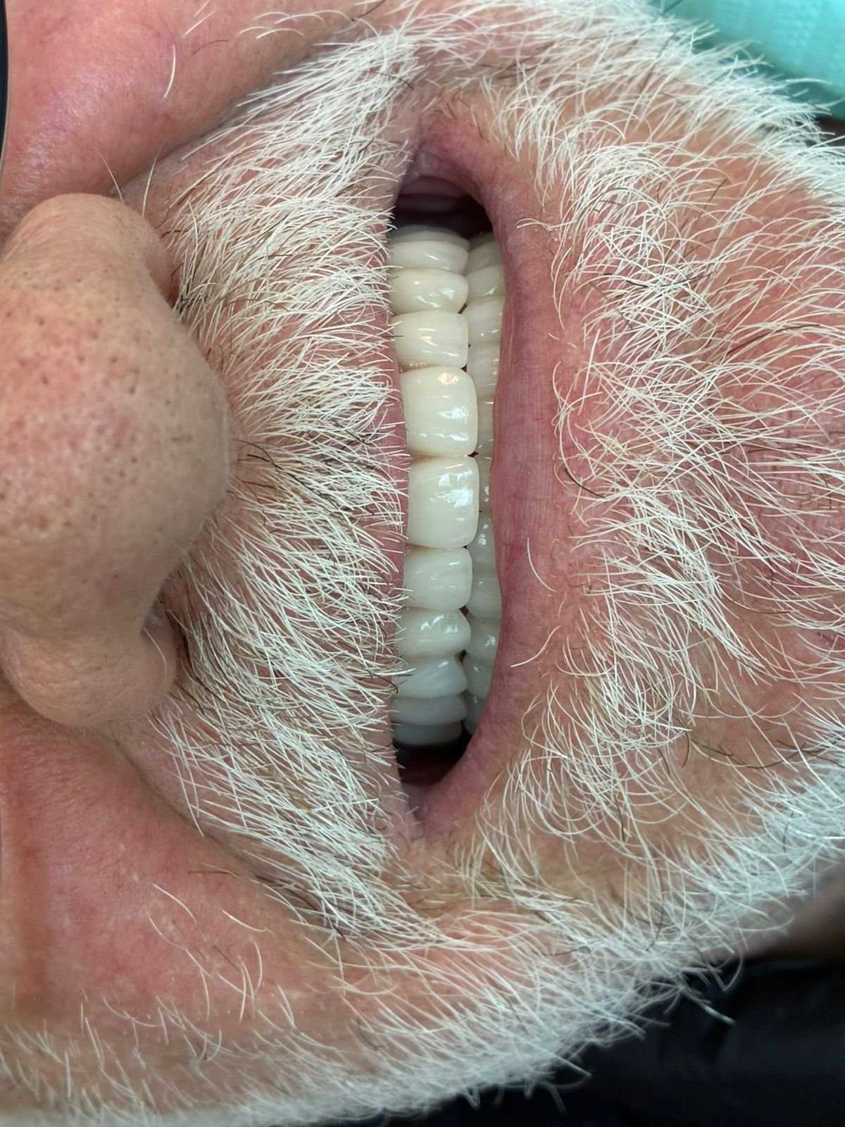 Imagem ilustrativa de Prótese Overdenture 3
