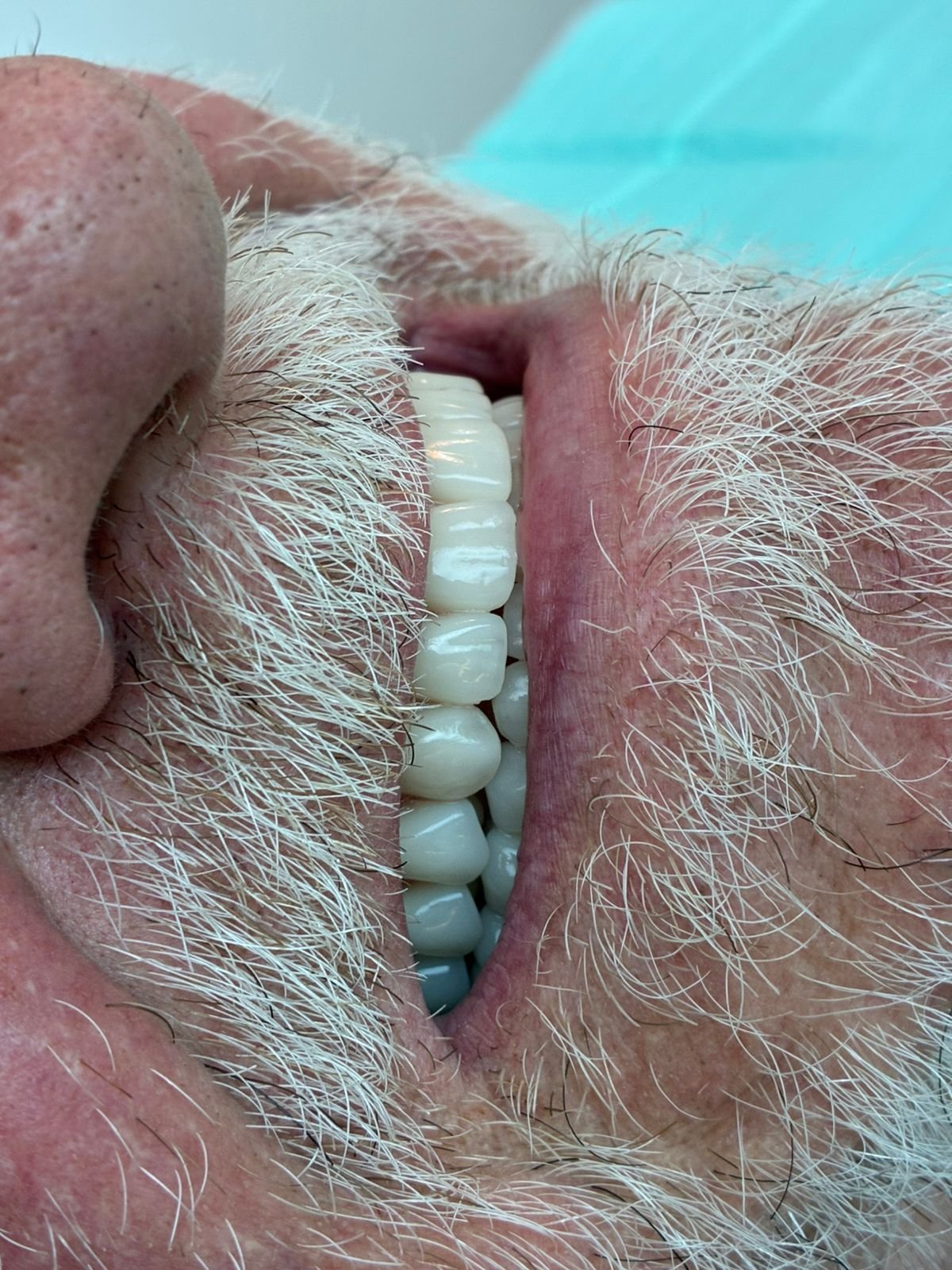 Imagem ilustrativa de Prótese Overdenture 2