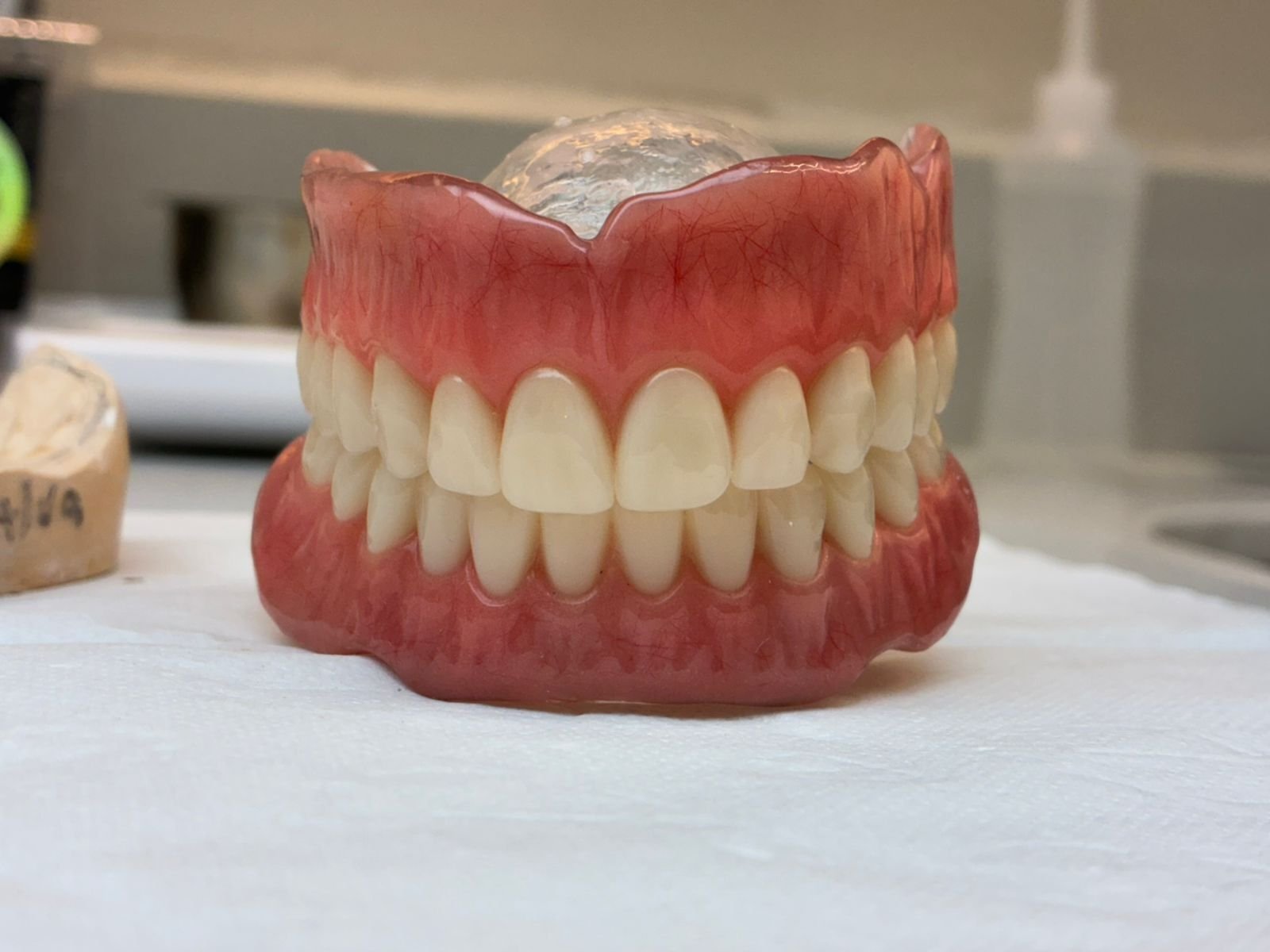 Prótese Overdenture - Resultado Natural e Confortável